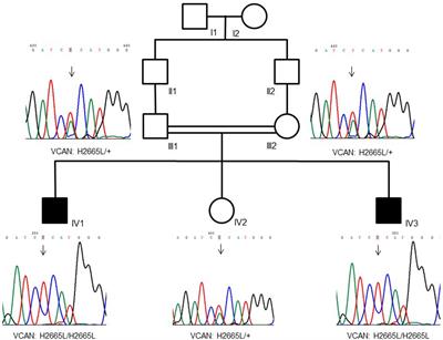 Homozygous Recessive Versican Missense Variation Is Associated With Early Teeth Loss in a Pakistani Family